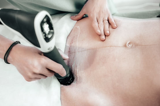 Eine Frau erhält eine Stosswellentherapie an ihrem Bauch.